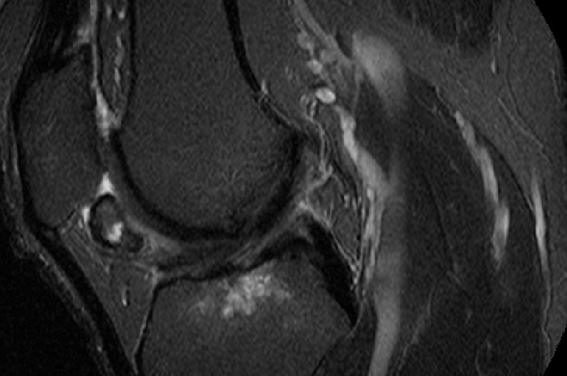 Characterization of Bone Marrow Lesions in Human Knee Osteoarthritis