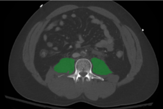 Muscle Loss and Weakness in Critical Care
