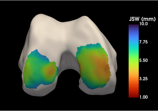 Investigating The Relationship Between Bone and Joint Parameters in Knee Osteoarthritis